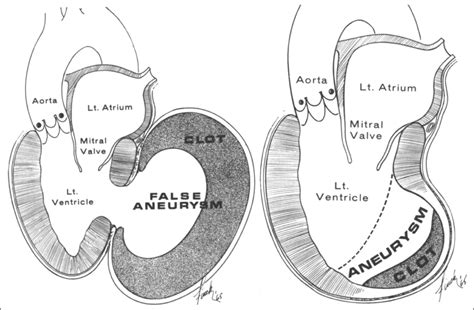 lv pseudoaneurysm vs true aneurysm.